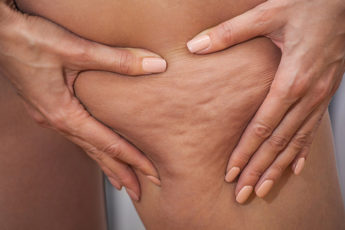 Nahaufnahme von Cellulite am Bein