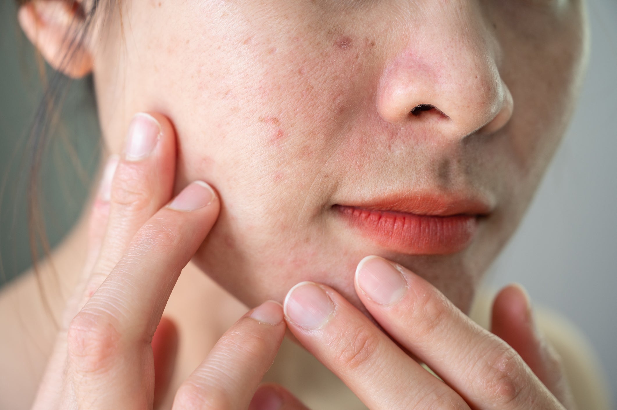 Gros plan de la joue d'une femme avec imperfections cutanées